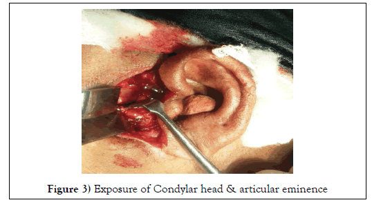 dental-oral-Condylar-head