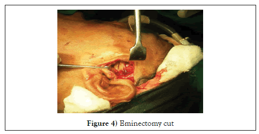 dental-oral-Eminectomy-cut