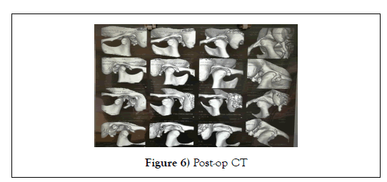 dental-oral-Post-op-CT