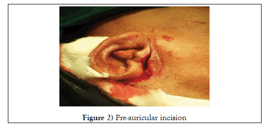 dental-oral-Pre-auricular-incision