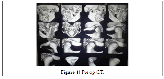 dental-oral-Pre-op-CT