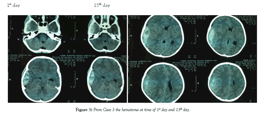 neurology-clinical-neuroscience-hematoma