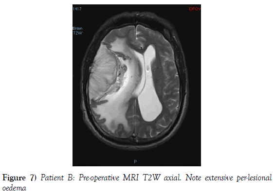 neurosurgery-Note-extensive-per-lesional