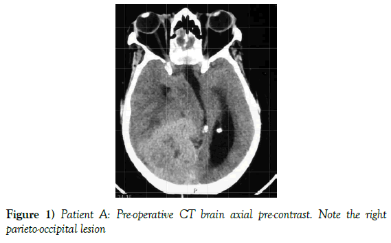 neurosurgery-Pre-operative-CT