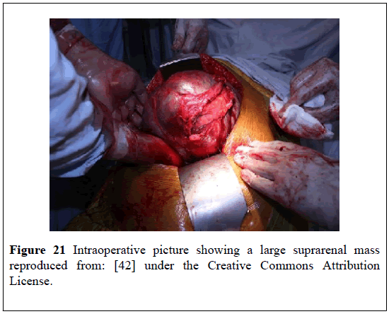 pulsus-journal-surgical-research-Intraoperative