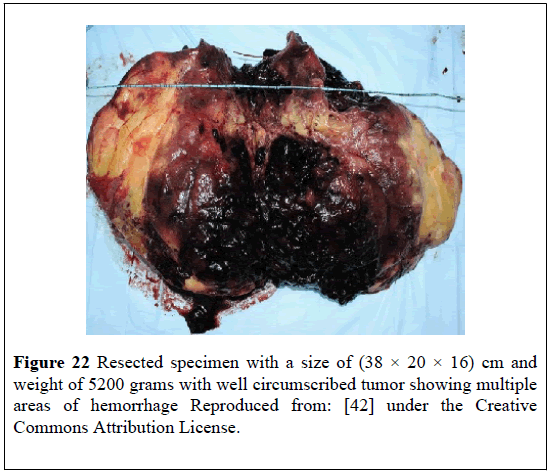 pulsus-journal-surgical-research-Resected-specimen