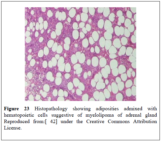 pulsus-journal-surgical-research-adrenal-gland