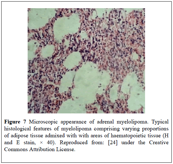 pulsus-journal-surgical-research-adrenal-myelolipoma