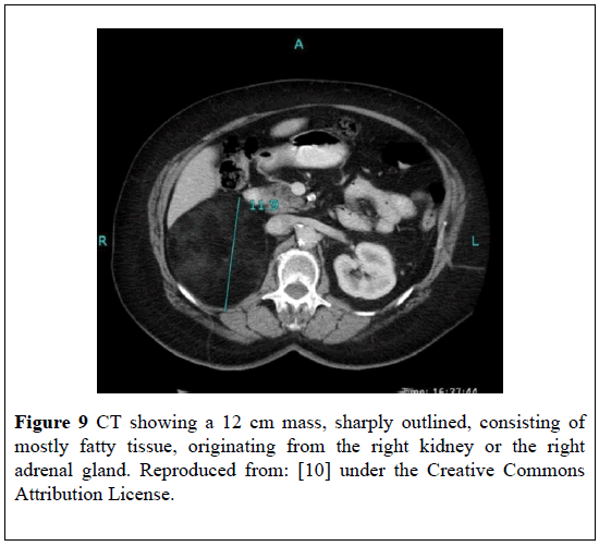 pulsus-journal-surgical-research-fatty-tissue