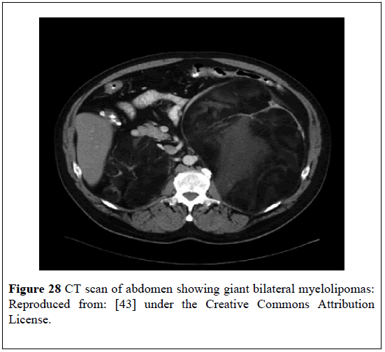 pulsus-journal-surgical-research-giant-bilateral