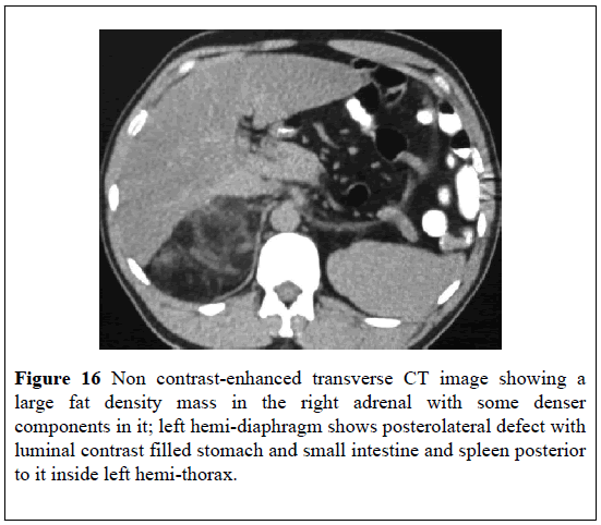 pulsus-journal-surgical-research-hemi-diaphragm