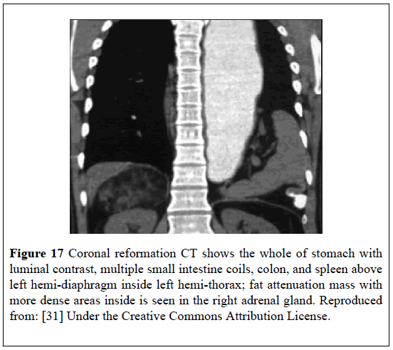 pulsus-journal-surgical-research-hemi-thorax