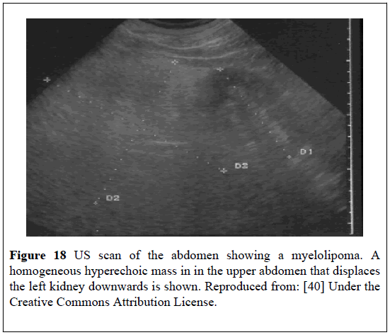 pulsus-journal-surgical-research-hyperechoic-mass