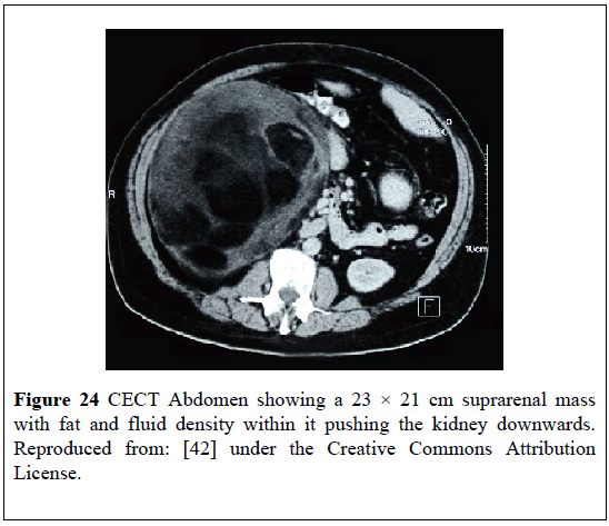 pulsus-journal-surgical-research-kidney-downwards