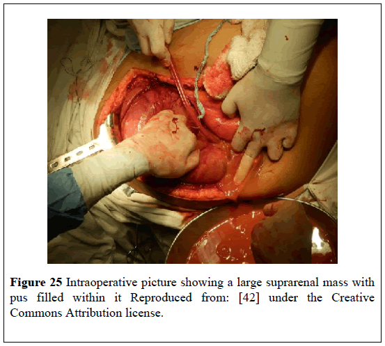 pulsus-journal-surgical-research-large-suprarenal