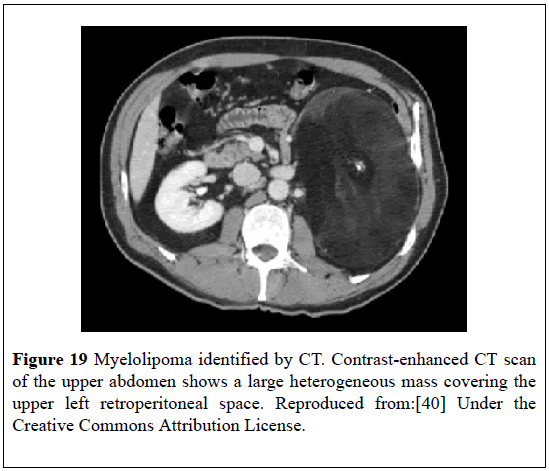 pulsus-journal-surgical-research-left-retroperitoneal