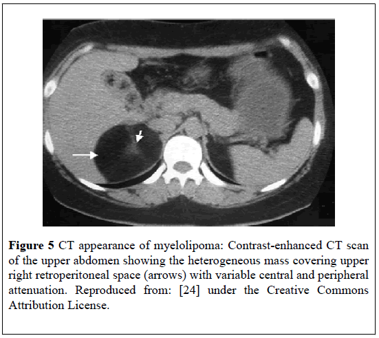 pulsus-journal-surgical-research-myelolipoma