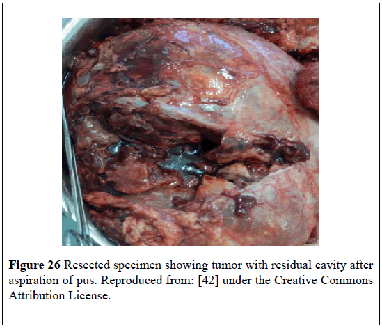 pulsus-journal-surgical-research-residual-cavity