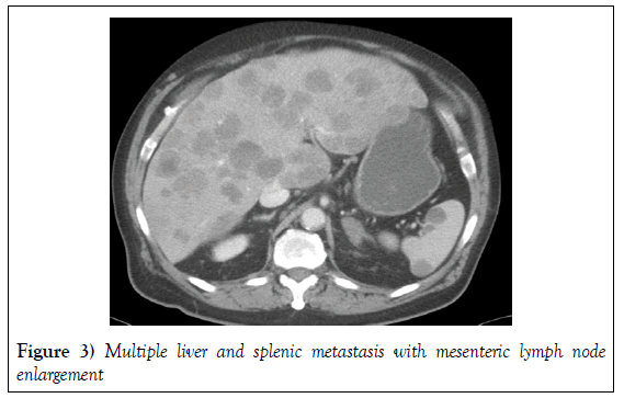 surgery-case-report-Multiple-liver