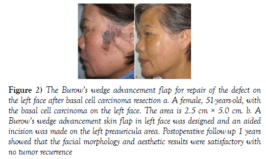 surgery-case-report-carcinoma-resection