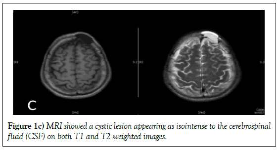 Non-traumatic intradiploic arachnoid cyst with growing swelling on the ...