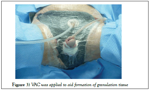 surgery-case-report-granulation