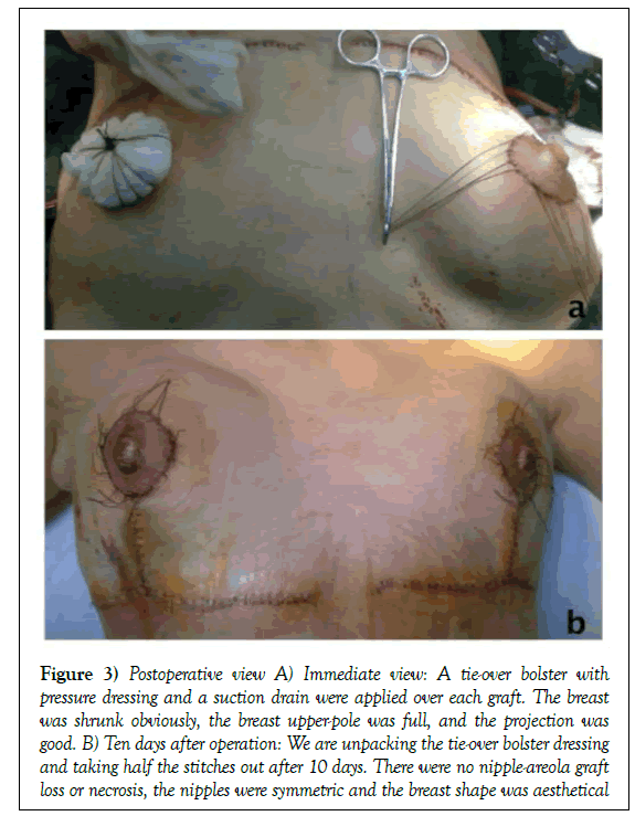 surgery-case-report-pressure-dressing