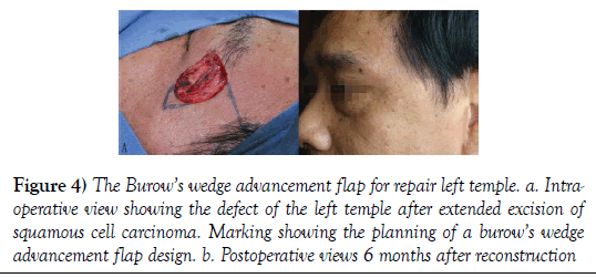 surgery-case-report-repair-left-temple