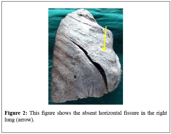 surgical-research-absent-horizontal-fissure