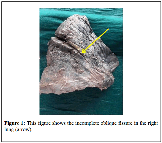 surgical-research-oblique-fissure