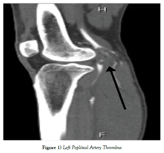 vascular-diseases-treatment-Thrombus