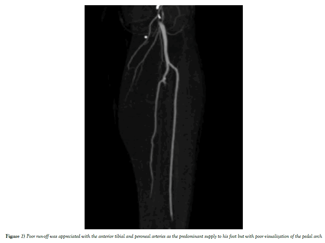 vascular-diseases-treatment-pedal-arch